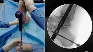 DualCompression Hindfoot Fusion Nail Surgical Technique With Chris Coetzee, MD
In this full‑length surgical demonstration, we walk step‑by‑step through the DualCompression Hindfoot Fusion Nail System technique, showing how to safely approach tibiotalocalcaneal (TTC) fusion using static and dynamic compression technology.
Beginning with exposure of the ankle joint through the universal anterior incision, between tibialis anterior and extensor hallucis longus, the surgeon works within a safe zone free of major neurovascular structures. Once the transverse vein is encountered and cauterized, the joint is entered, osteophytes are removed, and soft tissue is cleared to improve visualization.
The ankle joint is then fully prepared. All cartilage from the talar neck through the posterior tibial surface is removed, optionally including medial and lateral gutters to increase ease of reduction. With the lamina spreader in place, the joint opens for better access to subchondral bone, which can be stimulated using a burr, drill holes, or an osteotome. After ankle prep, the surgeon verifies reduction, ensuring a 90° neutral position and proper talar apposition—even if 5–10% posterior cartilage remains, which is acceptable in neutral alignment.
Attention then shifts to thorough subtalar joint preparation, an essential step for tibiotalocalcaneal (TTC) fusion. An incision is made over the sinus tarsi, taking care to identify safe anatomical planes. The posterior facet is exposed, cartilage removed from calcaneal and talar sides, and preparation is extended into the middle and anterior facets. Adequate visualization allows confirmation of complete cartilage removal—often aided by seeing the flexor hallucis longus (FHL) excursion. Deformity correction (varus/valgus) can be performed via lateral or medial wedge removal as required. Once both joints are fully prepared, the ankle and hindfoot are reduced to neutral with ~5° hindfoot valgus.
A large plantar incision is created to support instrumentation. Fluoroscopy is now required. The guidewire is placed aiming toward the lateral process of the talus on the lateral view, and centered within the calcaneus on the axial view—the most critical part of achieving proper alignment. Once satisfied, reaming begins: starting with the initial reamer into calcaneus, followed by sequential reamers sized 9, 10, 11, and 12 mm. Laser depth marks (180, 210, 240 mm) ensure adequate tibial depth for the 210‑mm nail.
Bone grafting is performed before nail insertion using ArthroCell™ delivered into both ankle and subtalar joints to fill voids and stimulate fusion. Radiopaque tips assist in fluoroscopic confirmation. The nail’s nitinol cable assembly is tightened prior to insertion to ensure proper dynamic compression function. The guidewire is removed, and the nail is inserted retrograde under fluoroscopy to a depth just beneath the calcaneal cortex.
Screw fixation follows:
Posterior calcaneal screw (slot #1)
Medial tibial screw (#2 position)
Optional talar screw
Lengths are selected using depth gauges and adjusted for guide clearance. Static compression (≈900 N) is applied through the cable system, visibly opening the calcaneal–talar interface, followed by dynamic compression via the nitinol component. The second calcaneal screw locks into the nitinol system to maintain ongoing compression throughout healing.
After removing the cable, the construct is complete. Post‑op protocol includes splinting for two weeks, heel‑touch weight‑bearing, and full weight‑bearing by six weeks. This video provides a comprehensive, reproducible, and high‑yield approach for mastering the full TTC fusion workflow with the DualCompression Hindfoot Fusion Nail.
👇 Helpful Arthrex Reference Links:
https://arthrex.info/4o9XaGL
Nitinol Compression Technology Overview: https://www.arthrex.com/foot-ankle/fusion
👍 Like, subscribe, and comment if you’d like to see more patient success stories and innovations in minimally invasive orthopedic procedures.
Arthrex is a global leader in orthopedic surgical innovation, dedicated to advancing minimally invasive techniques and medical education. Our mission is to help surgeons treat their patients better by providing cutting-edge products, expert training, and comprehensive resources for orthopedic procedures, including sports medicine, joint preservation, and trauma care.
Stay Connected: 👍 Subscribe to our channel for the latest in orthopedic surgical techniques and product updates.
📱 Follow Arthrex on:
LinkedIn: / https://www.linkedin.com/company/arthrex/
Facebook: / https://www.facebook.com/Arthrex/
Instagram: / https://www.instagram.com/arthrexmeded/
X: https://x.com/arthrex DualCompression Hindfoot Fusion Nail Surgical Technique With Chris Coetzee, MD