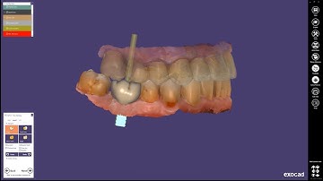 NEW: exocad ChairsideCAD 2.3 Matera