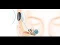How the Cochlear™ Nucleus® Kanso™ Implant System Works