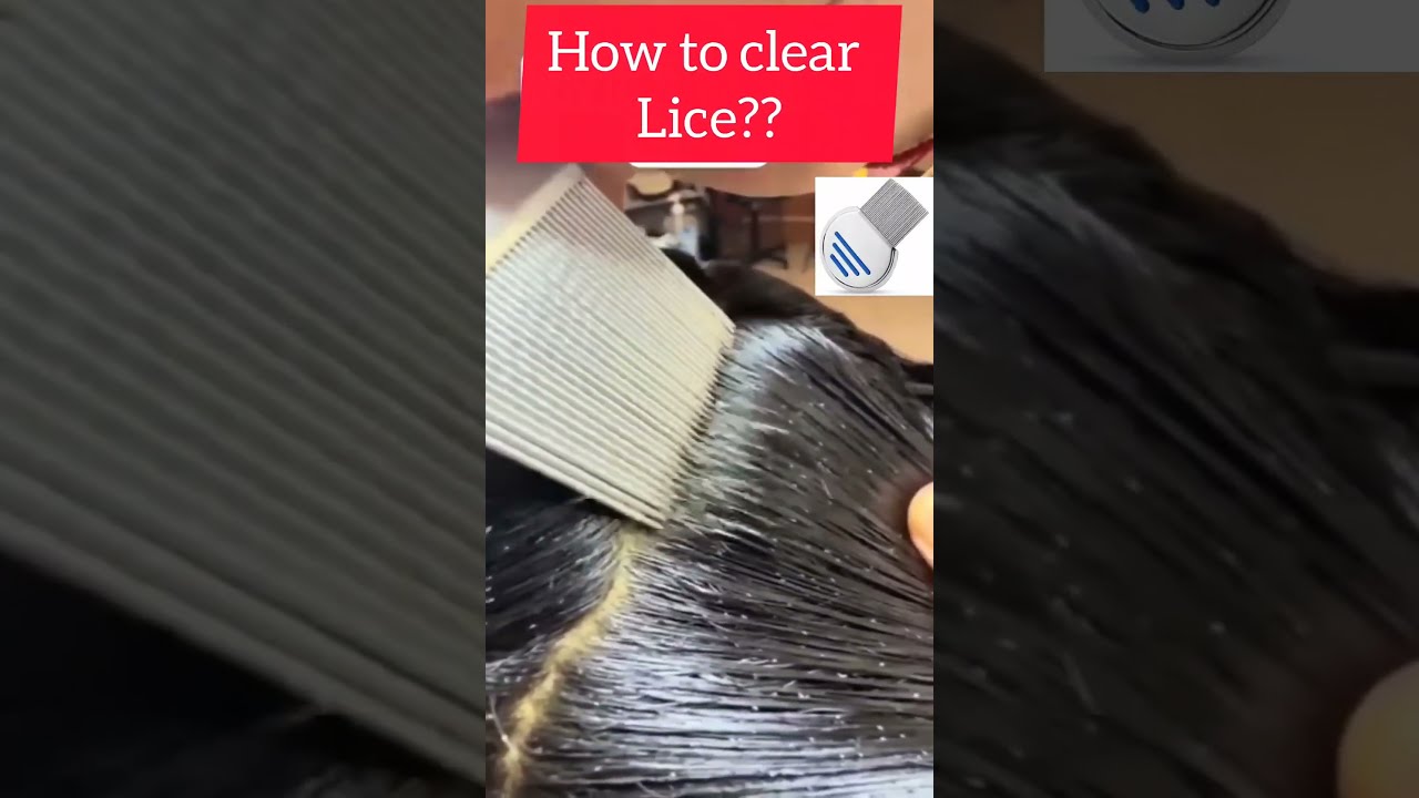 Lice Removal Get Rid Of And Nits Liceremoval Licecomb Licetreatment Piojos
