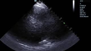 Cases from the Coop: Acute Pulmonary Embolism