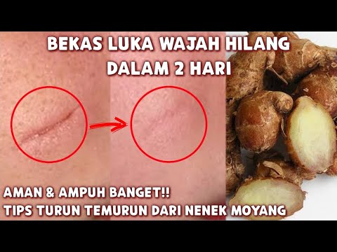 Video: 3 Cara Mudah Mencegah Bekas Luka di Wajah