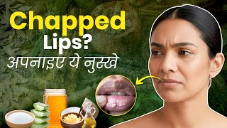 फटे होंठों के लिए 5 असरदार घरेलू नुस्खे | Chapped Lips Home Remedies I Aasan Nuskhe Behtar Zindagi screenshot 2