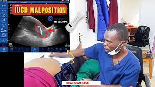 Tri Scan Max | Malpositioned IUD on Pelvic Ultrasound | Gynecologic Case | Dr Sono