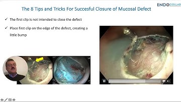 8 Tips For Efficient Closure of Mucosal Defects