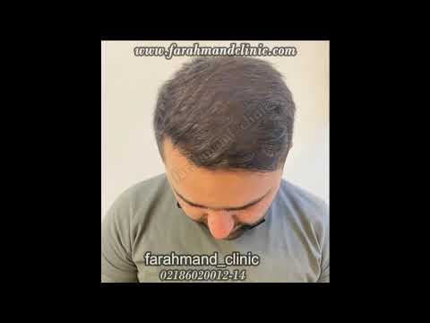 ویدیو قبل و بعد کاشت مو