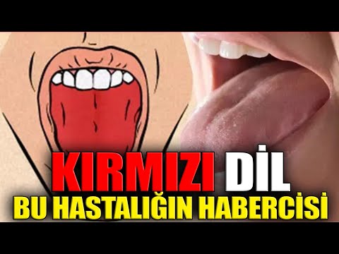 Dili Beyaz, Sarı ve Kırmızı Olanlar, Hastalık Bu Renklerle Kendisini Gösteriyor!