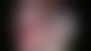 Laparoscopic Partial Gastrectomy for Fundal GIST  - Dr Karthik Babu Perumalla