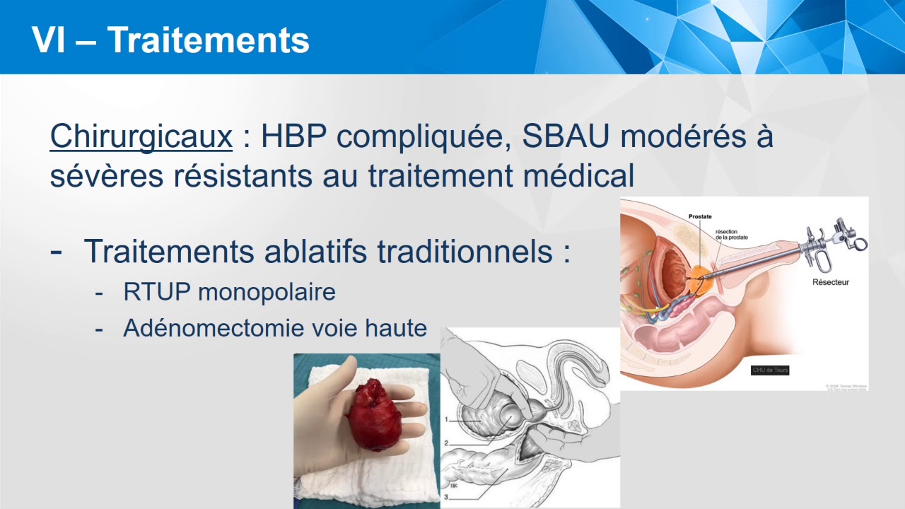 nouveau traitement adenome prostate 2019