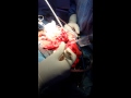 Excision of Haemangiopericytoma.Dr Rajiv Jha Nepal