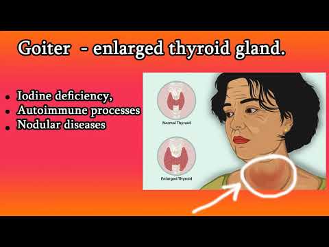 Video: Goiter - Causes, Symptoms, Diagnosis And Treatment Of Goiter
