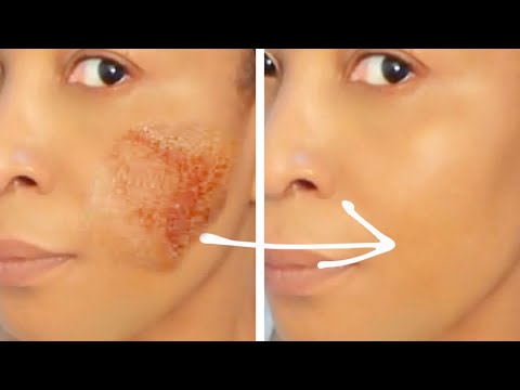 SKINCARE, HOW TO REMOVE FACE PIGMENTATION NATURALLY, Dark Spots, Black Patches + Acne Scars