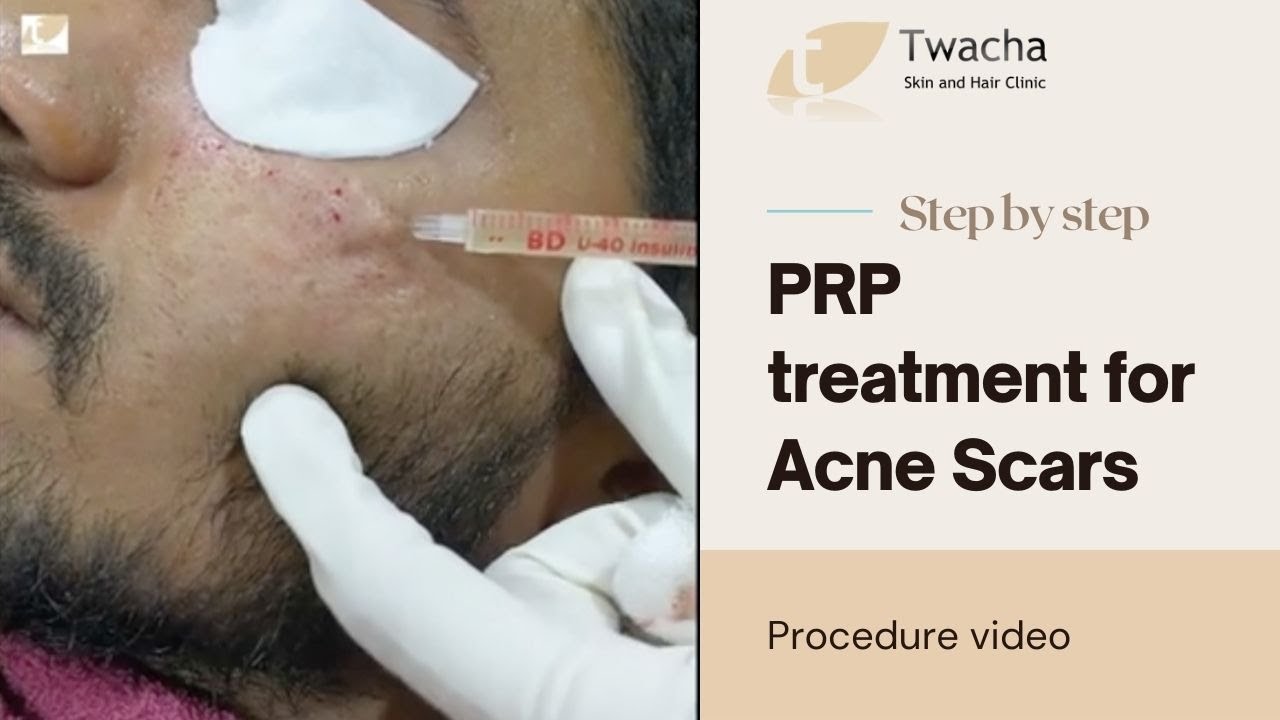 PRP treatment for acne scars PRP treatment Kochi Twacha Skin and Hair