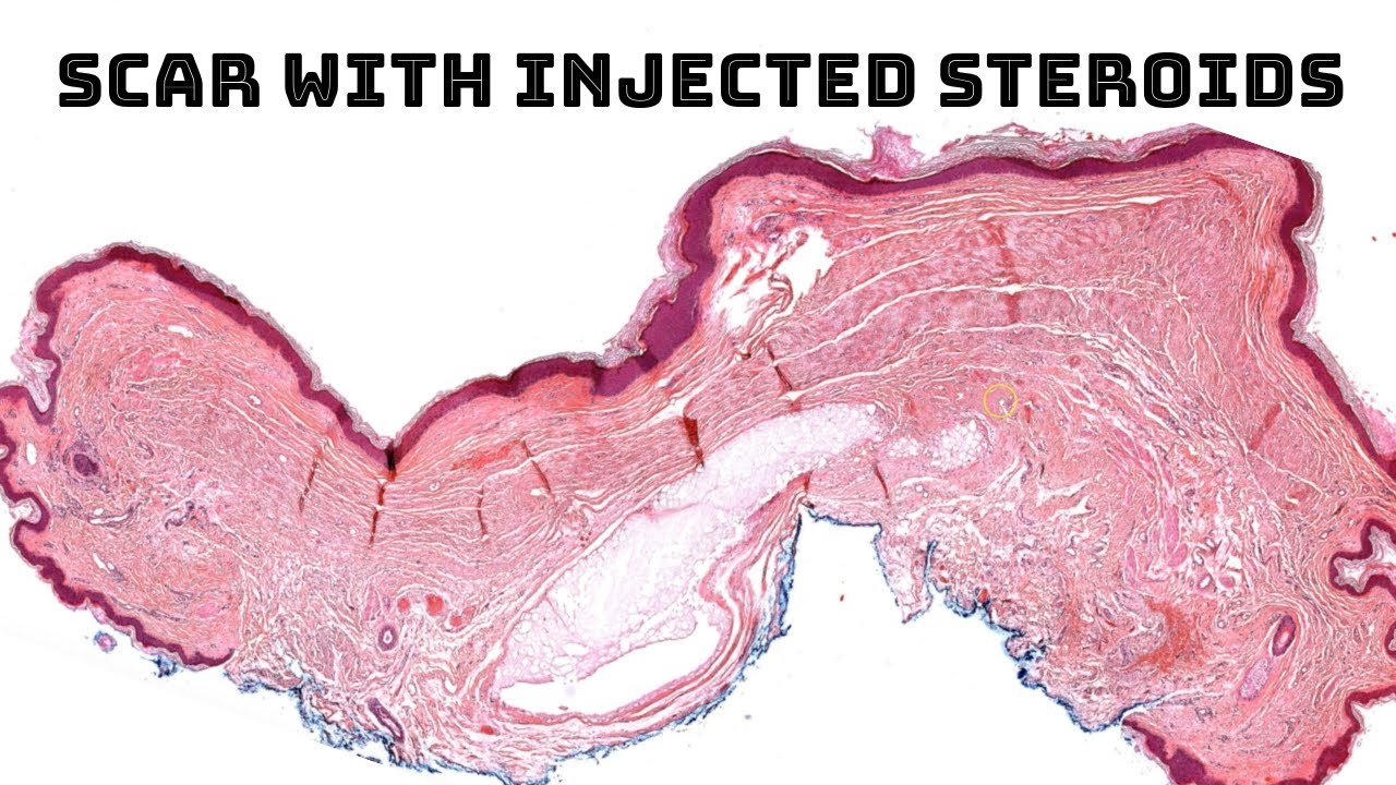 Scar With Injected Steroids Kenalog Triamcinolone Pathology Dermpath Scar With Injected Steroids Kenalog Triamcinolone Pathology Dermpath