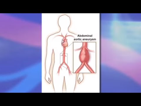 Risks and Benefits of Endovascular Abdominal Aortic Aneurysm Repair (EVAR)