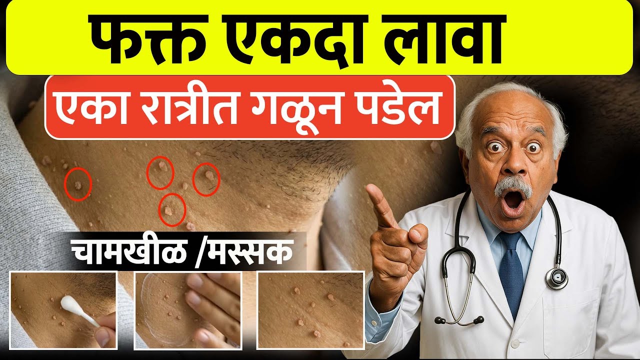 चामखिळी का तयार होते? | Wart Causes | Best Wart Treatment By Rajendra Bhosale