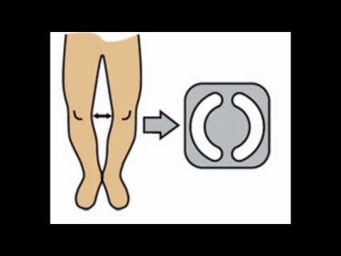 Bow legs, knock knees, genu vBasketballm correction treatment exercises