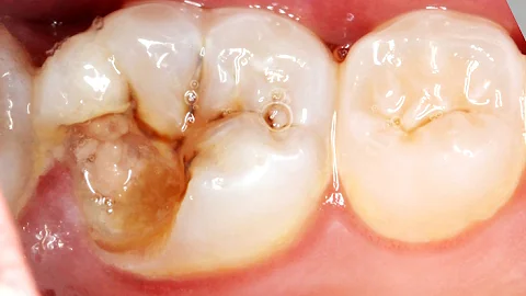 Tem como restaurar um dente furado?