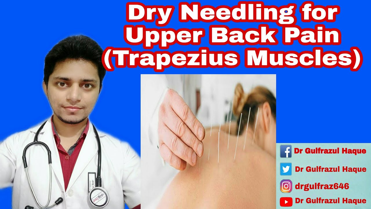 Dry Needling for Back Pain Physiotherapy Upper back pain Dry Needling Physio 
