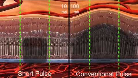 Pascal Argon Laser Photocoagulator