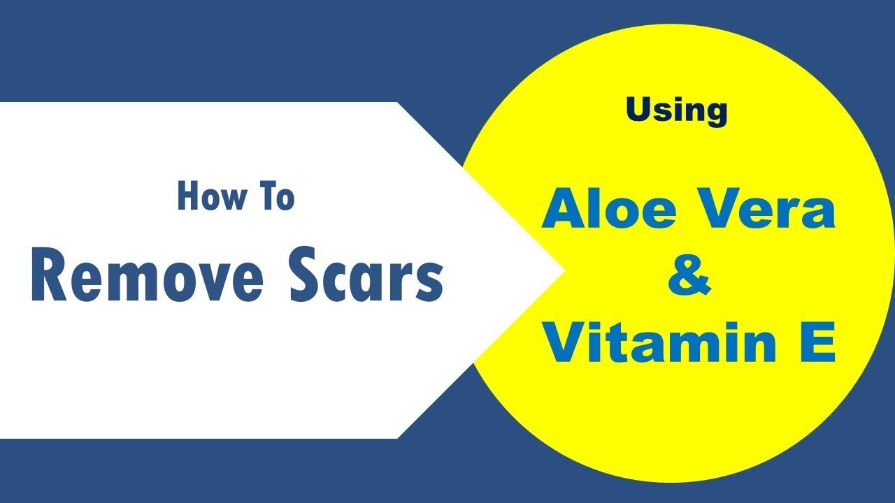 Tips To Use Aloe Vera And Vitamin E For Scars - How To Remove Scars ...