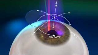 Jacksonville LASIK iris tracker demonstration