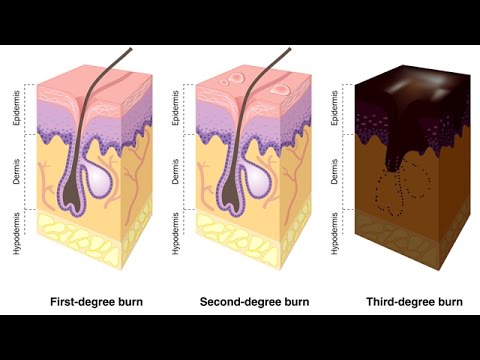 Видео: Yanıklar Nasıl Derecelendirilir?