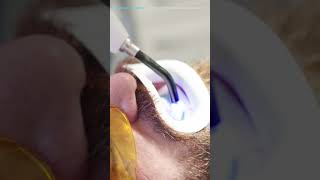 تبييض الأسنان بالليزر/ Teeth whitening