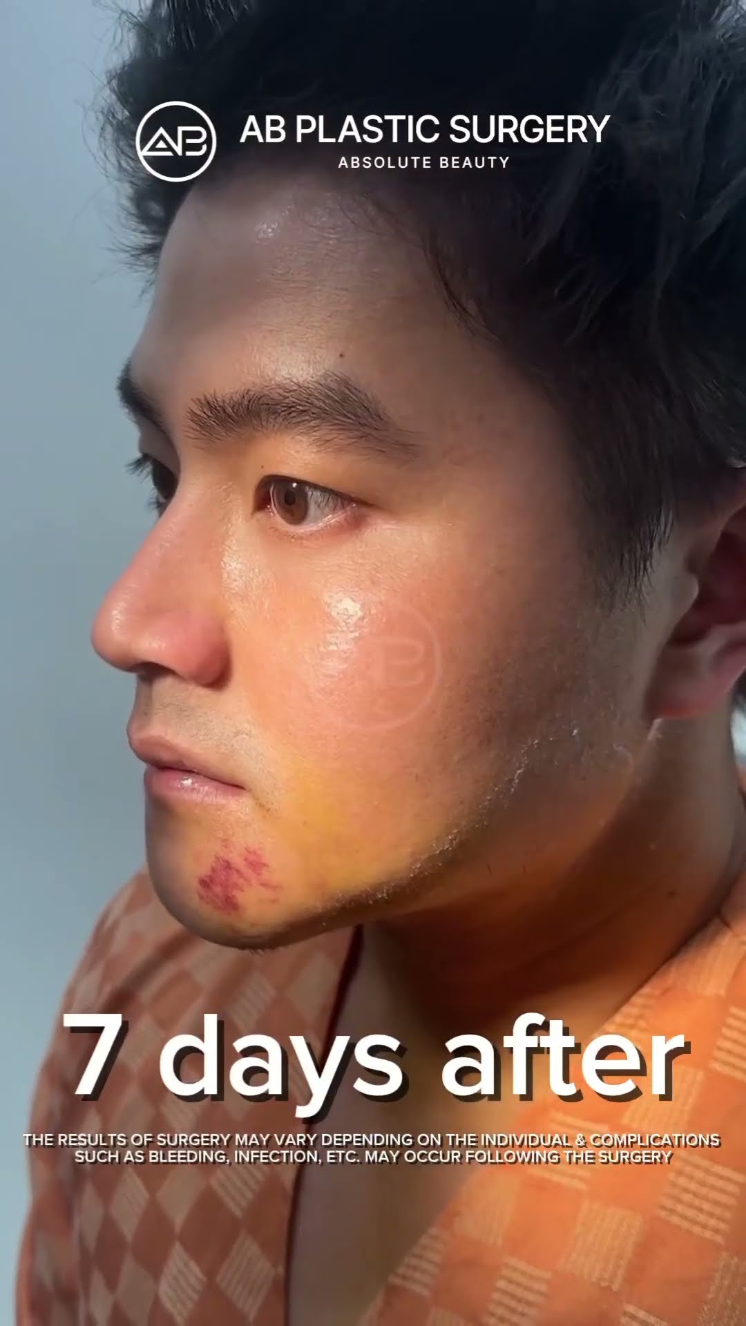[Best Plastic Surgery in Korea] Face Lifting + Face Liposuction for man #abplasticsurgery