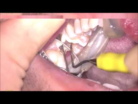サイナストラクトのある根管治療　Sinus tract