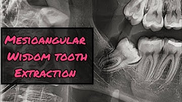 Mesioangular Wisdom Tooth Extraction Step-by-Step