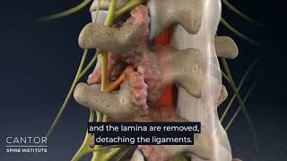 What is Ultrasonic Laminaplasty?