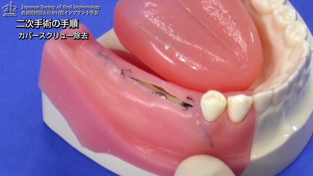 動画コンテンツ（インプラント）｜株式会社ニッシン｜歯科模型・歯科