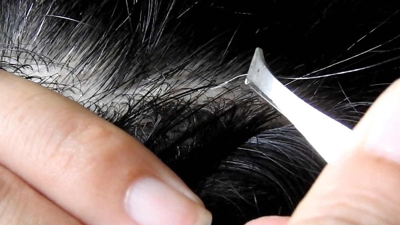 Satisfying ingrown hair Pulling Juicy Gray Hair Part 35 YouTube