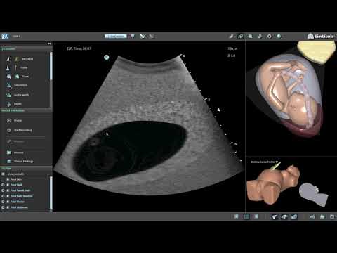 Wideo: Niskie Ciśnienie Krwi Podczas Ciąży W I Trymestrze, II Trymestrze, III Trymestrze