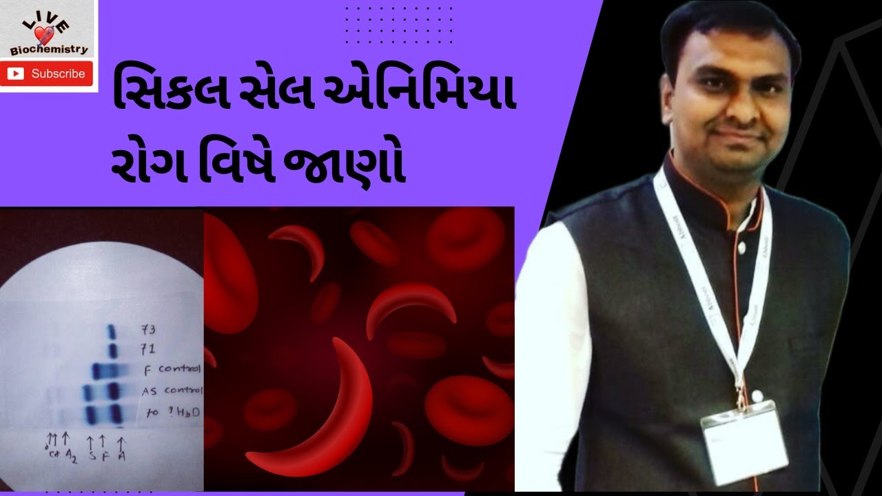 Sickle cell anemia explained in Gujarati સિકલ સેલ એનિમિયા Sickle
