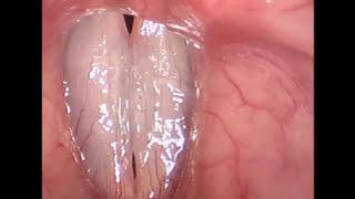 Rigid Stroboscopy Clinical Video
