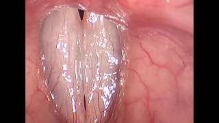 Rigid Stroboscopy Clinical Video screenshot 4