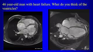 9 Cardiac and Pericardial Tumors