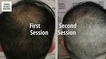 Scalp Micropigmentation  FUE Scar Camouflage & Crown Density