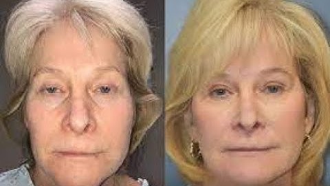 Rhytidectomy CPT code - simplify medical coding