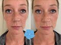 Juvederm Voluma Cheek Filler Treatment | Before + After | Nashville PA