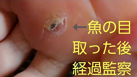 تحميل 魚の目 芯 抜く
