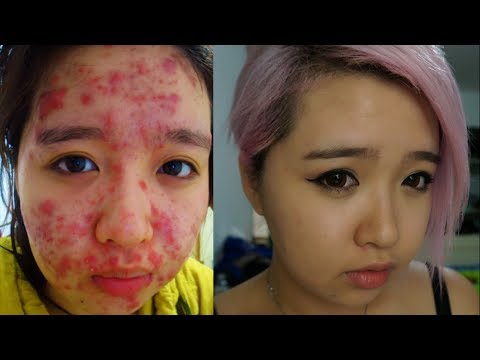 From Severe Acne to Clear Skin