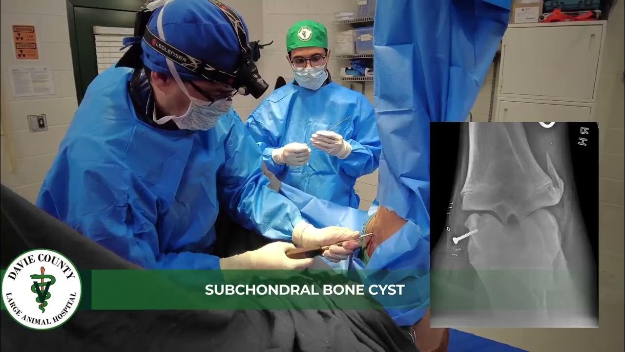 Dclah services subchondral bone cyst surgery youtube