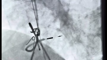 Conduction System Pacing CSP (Left bundle branch pacing)