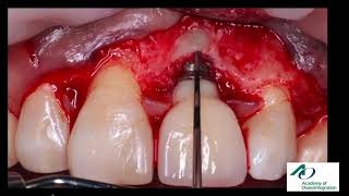 Enhancing Peri-implant Esthetics, Health and Patients’ Comfort With Autogenous Soft Tissue Grafts screenshot 5
