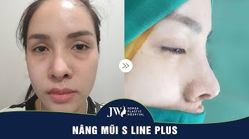 90 phút giải cứu chiếc mũi biến dạng cho cô gái trẻ bằng công nghệ S Line Plus