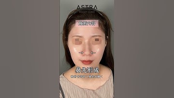 鼻天才TWICEサナちゃん✨の鼻になれる？！#astrabeautyclinic #アストラビューティクリニック #鼻整形 #美容整形 #twice#サナ