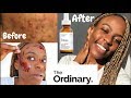 SKIN | How To Get Rid of Acne & hyperpigmentation Using THE ORDINARY | SKINCARE ROUTINE